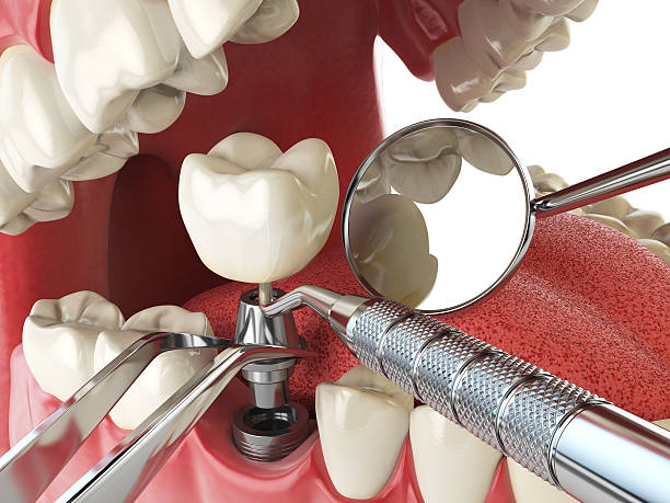 Best Knocked-Out Tooth Emergency  in Tokeneke, CT